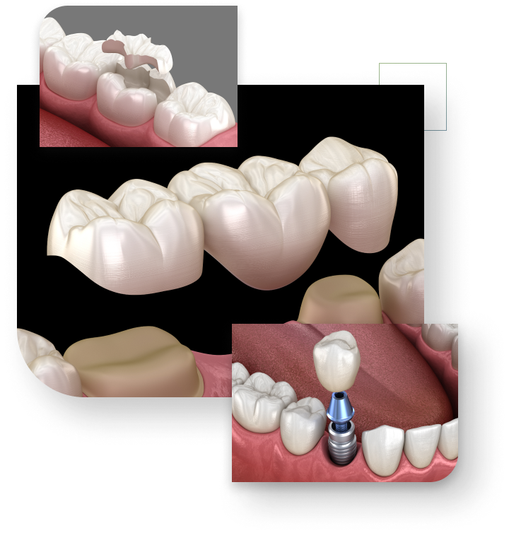 models of dental restrorations