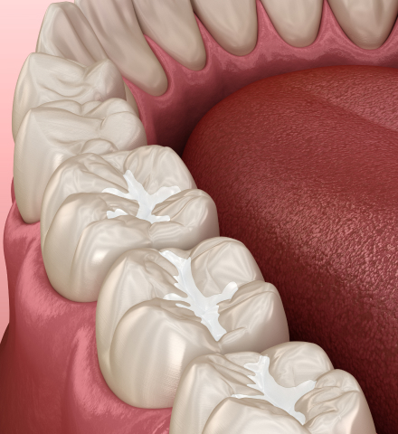 model of dental fillings