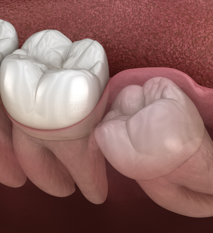 impacted teeth model